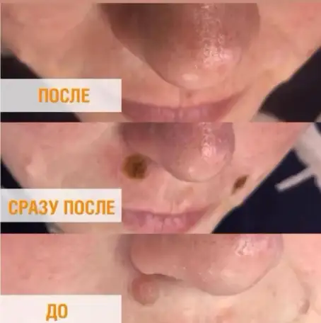 Лазерное удаление бородавок, родинок., фотография 4