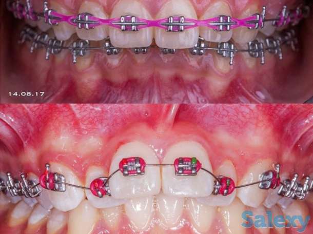 Брекеты недорого, фотография 1