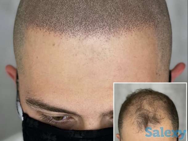 Трихопигментация головы в Алматы, фотография 1