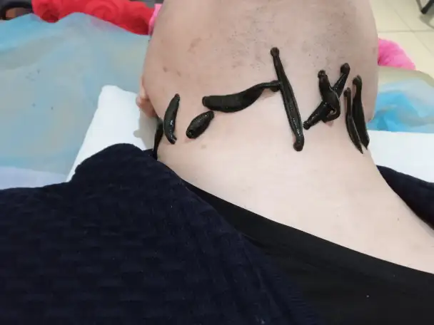 лечение пиявками профессионально недорого, фотография 2