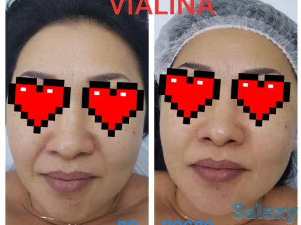 Смас лифтинг, фотография 10