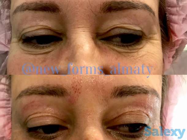 Аппаратная косметология для лица и тела, фотография 5