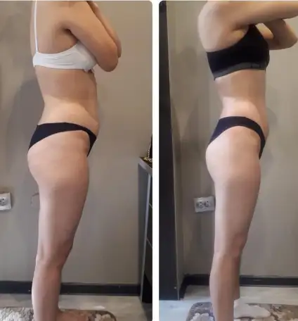 Антицеллюлитный массажКоррекция фигуры, фотография 2