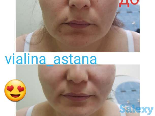 Смас лифтинг, фотография 7