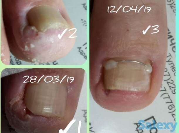 Решение проблем стоп и ногтей в Алматы, фотография 5