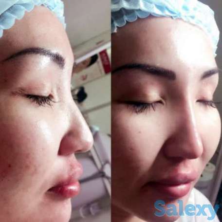 Увеличение губ от 20000 тг., фотография 1