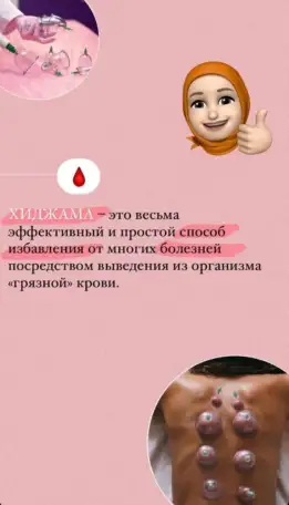 Хиджама в Астане. Услуги хиджамы, фотография 6