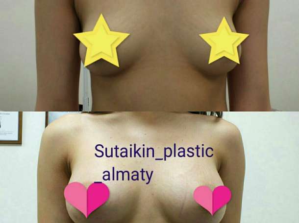 Увеличение груди в Алматы, фотография 3