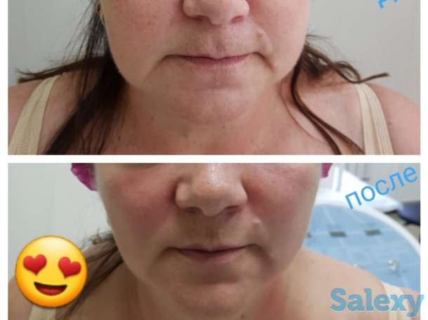 Смас лифтинг, фотография 5