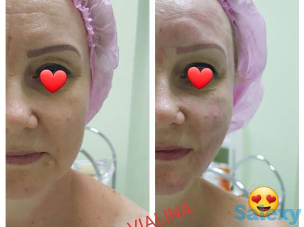 Смас лифтинг, фотография 8