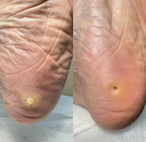 Педикюр Kart, медицинский, фотография 5