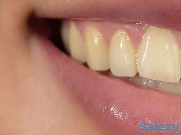 Отбеливание для зубов Happy Smile, фотография 8