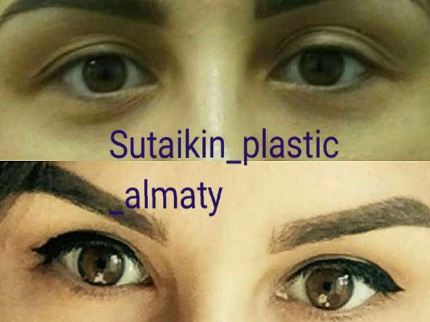 Блефаропластика в Алматы, фотография 3