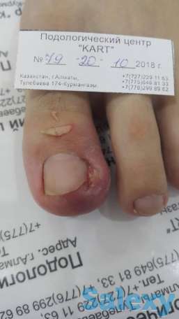 Решение проблем стоп и ногтей в Алматы, фотография 2