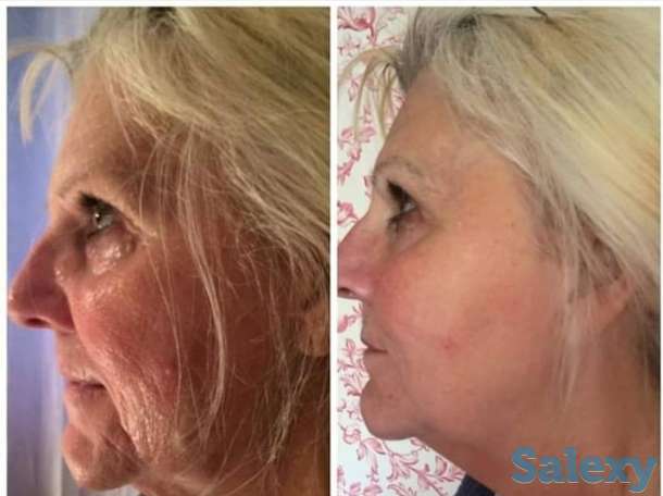 30минутная нехирургическая подтяжка лица Скиндалженс, фотография 5