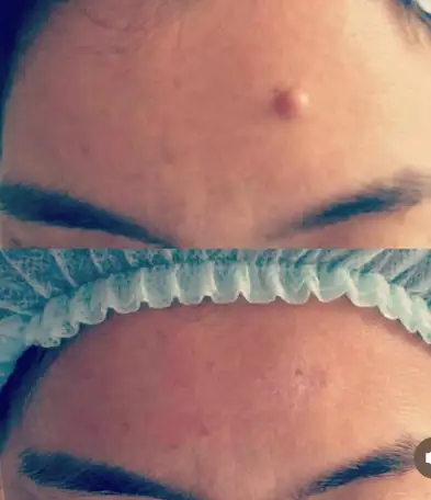 Лазерное удаление бородавок, родинок., фотография 2