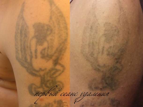 татуировки, татуаж, удаление, фотография 3