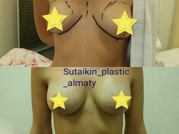 Увеличение груди в Алматы, фотография 4