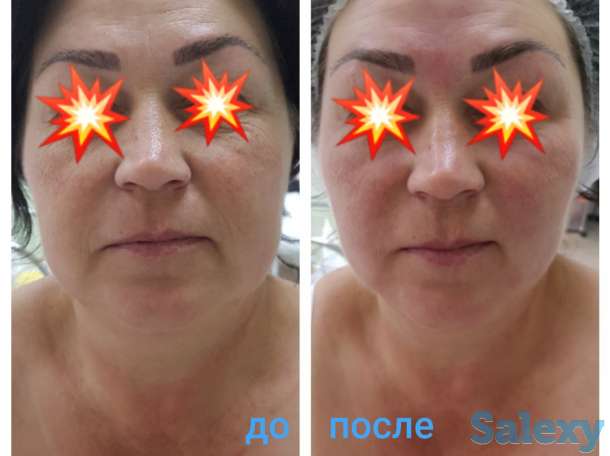 Смас лифтинг, фотография 3