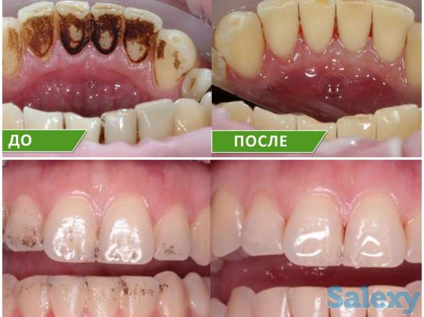 Профессиональная чистка зубов!!!!!Лучшая цена!!!!!Акция!!!!!, фотография 1