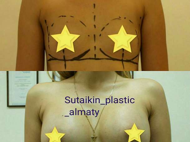 Увеличение груди в Алматы, фотография 5