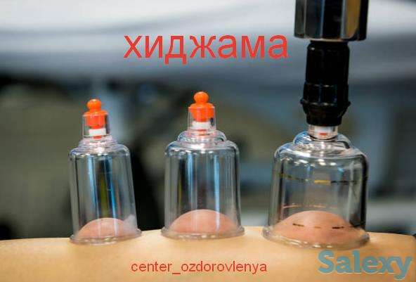 ПРОФЕССИОНАЛЬНАЯ ХИДЖАМА (кан алу), фотография 1