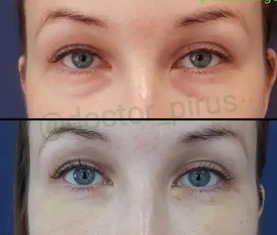 Блефаропластика, фотография 2