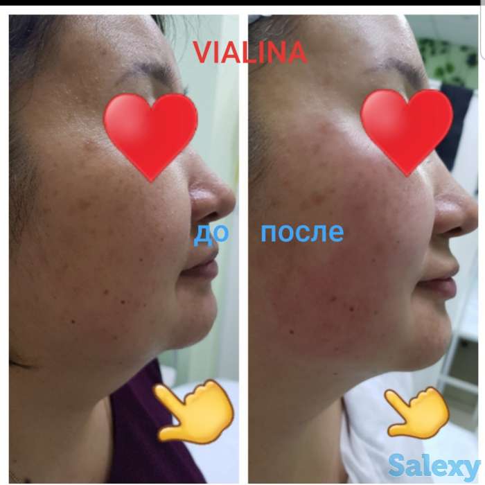 Смас лифтинг, фотография 4