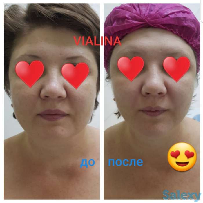 Смас лифтинг, фотография 6