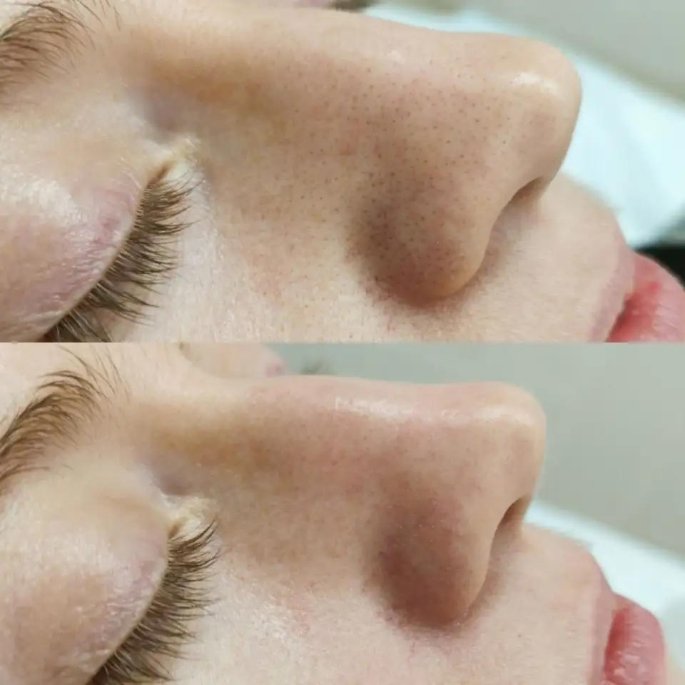 Приглашаю на первую БЕСПЛАТНУЮ косметологическую процедуру, фотография 3