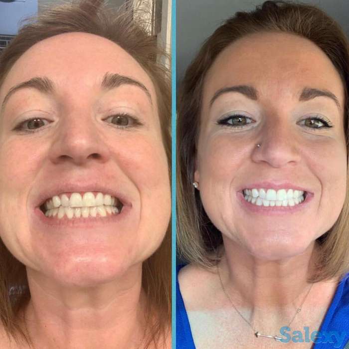 Отбеливание для зубов Happy Smile, фотография 10