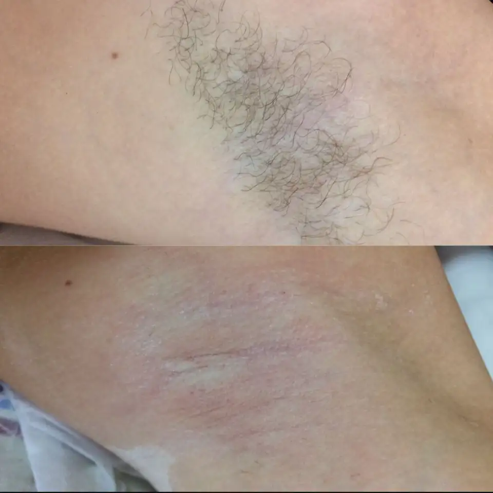 Шугаринг, фотография 2