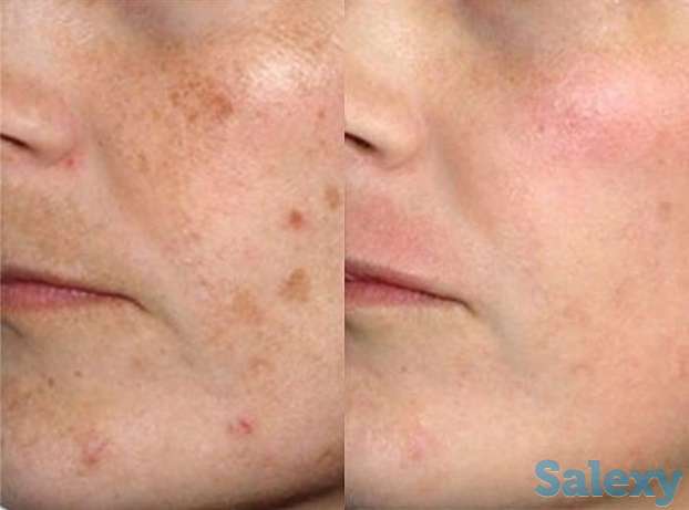 Пришло время бороться с пигментацией!!, фотография 1