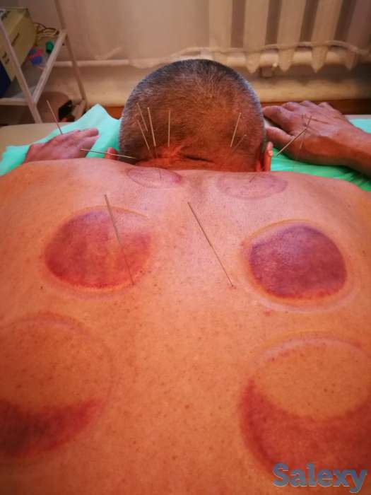 Иглотерапия, массаж, Хиджама, ЛФК, лечение огнём, баночный массаж, фотография 2