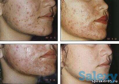 Хиджама, фотография 1