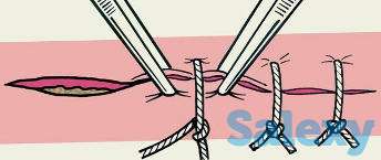 Снятие швов на дому, фотография 1