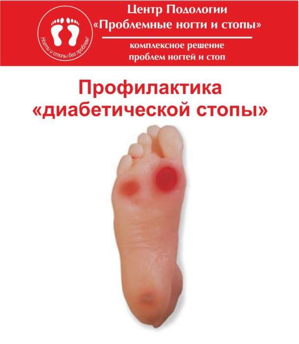 Профилактика сахарного диабета в Алматы, фотография 6