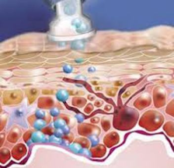 Кислородная безинъекционная мезотерапия, фотография 3