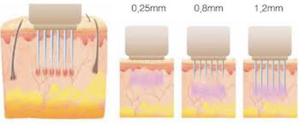 Омоложение лица – RF-лифтинг нового поколения, фотография 2