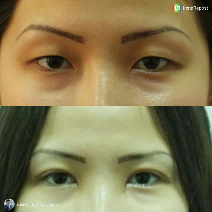 Блефаропластика в Алматы, фотография 4