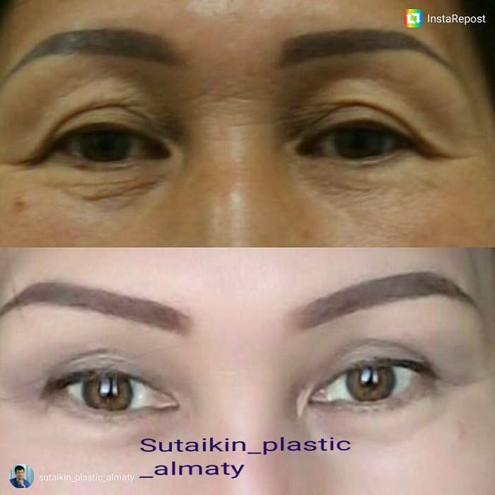Блефаропластика в Алматы, фотография 1