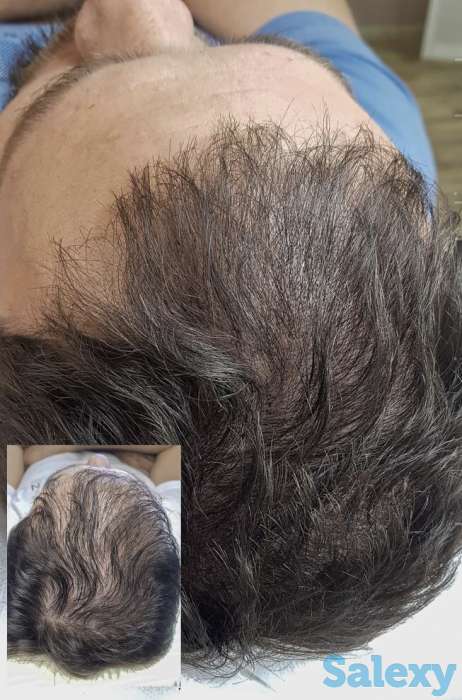 Трихопигментация головы в Алматы, фотография 4