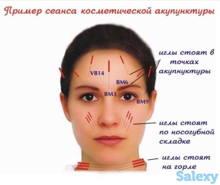 Аккурунктурная пластика лица, фотография 1