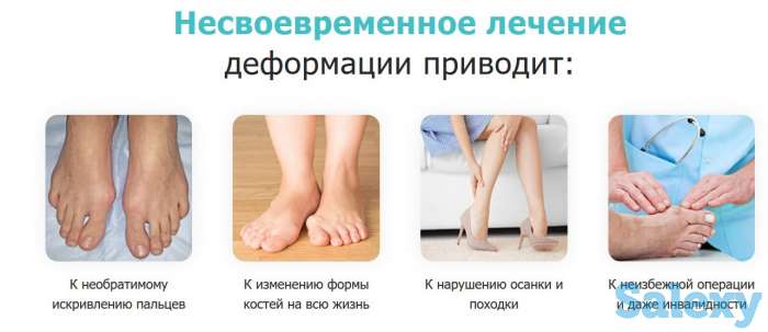 Магнитная вальгусная шина MagnetFix бандаж, фотография 2