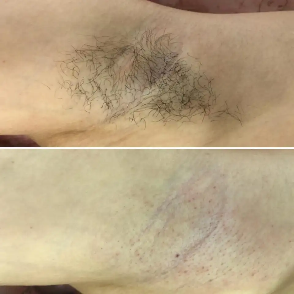 Шугаринг, фотография 1