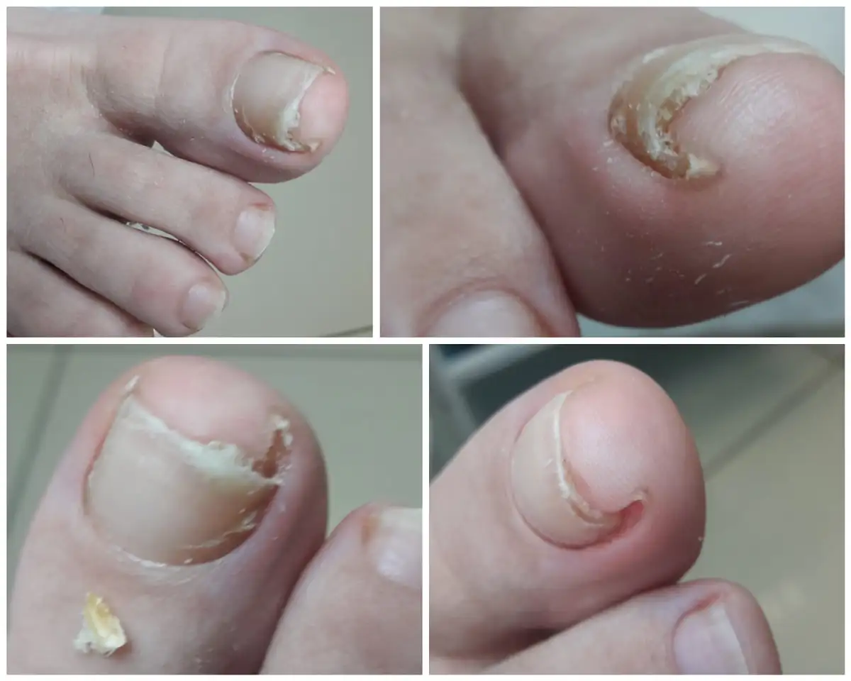 Заболевание ногтей, онихолизис ногтей, вросший ноготь!Подолог-миколог!, фотография 1