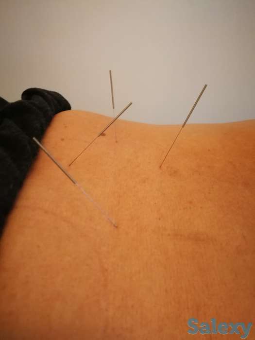 Иглотерапия, массаж, Хиджама, ЛФК, лечение огнём, баночный массаж, фотография 3