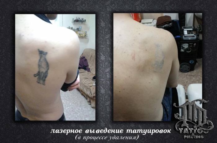 Удаление татуировок и татуажа в Алматы, фотография 3