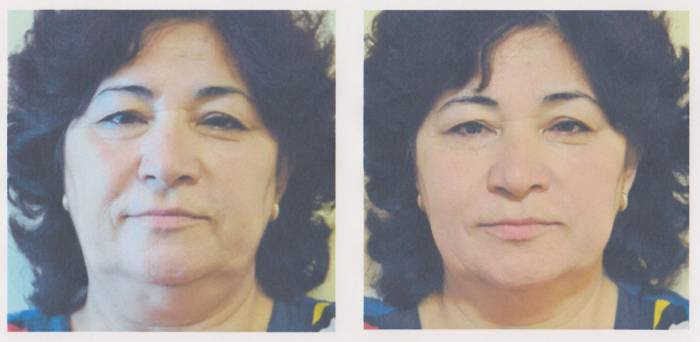 Лицо. Лифтинг. Эстетическое мануальное моделирование лица., фотография 1