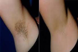 Шугаринг. Депиляция в Астане. Бикини-дизайн., фотография 6